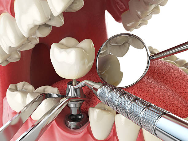 Best Emergency Tooth Extraction in Claremont, NH